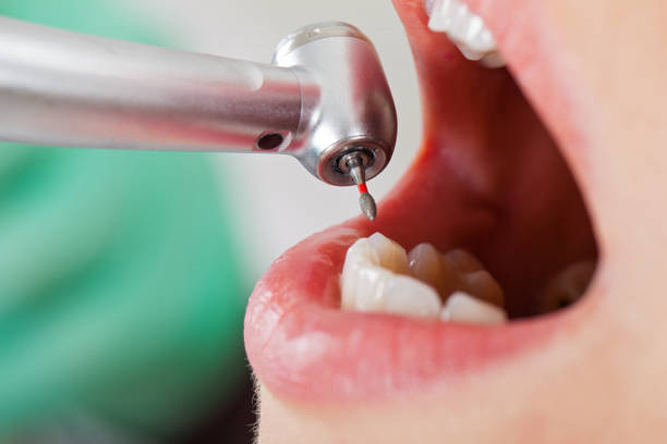 Best Emergency Tooth Extraction in Deer Park, TX